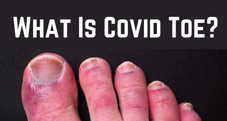 What Is Covid Toe